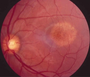 retina-stargardt-macula-ojo-de-buey